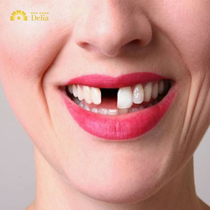 Mất 1 răng nên trồng răng Implant hay bắc cầu thì bền chắc hơn?