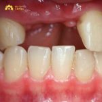 Mất 2 răng nên trồng Implant hay bắc cầu - Bác sĩ giải đáp