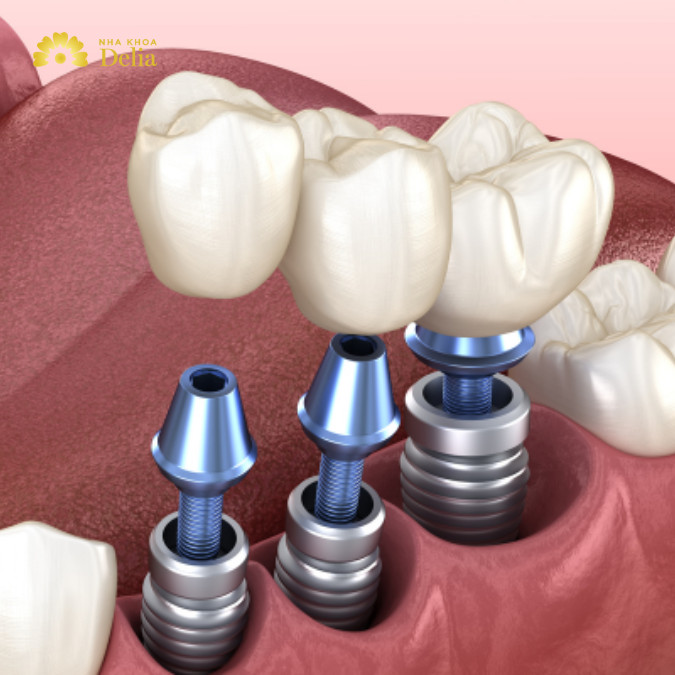 Tại sao nên trồng răng nhai càng sớm càng tốt? Hậu quả mất răng