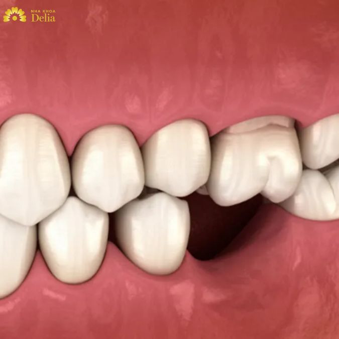 Trả lời câu hỏi: Mất răng số 5 có niềng được không?