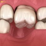 Mất răng nhai nên trồng răng Implant hay bắc cầu? Phương pháp nào tốt hơn?