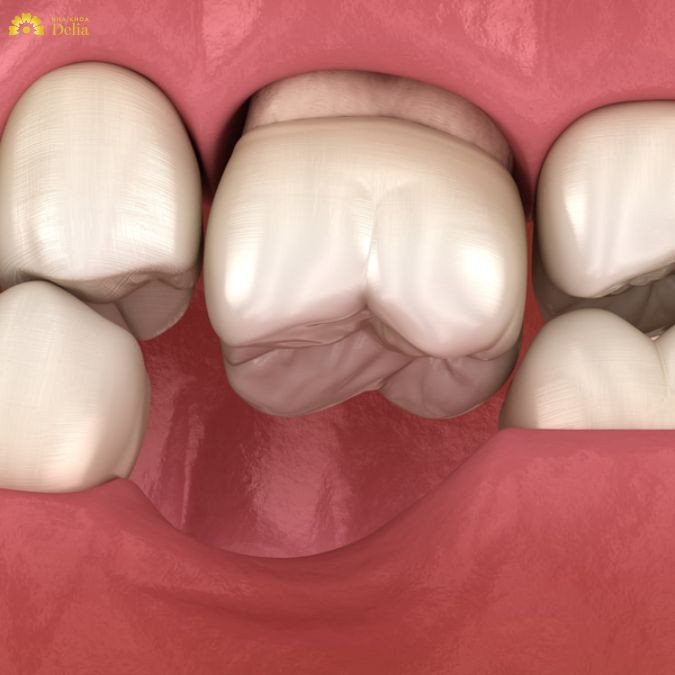 Trả lời thắc mắc: Mất răng số 6 có niềng răng được không?