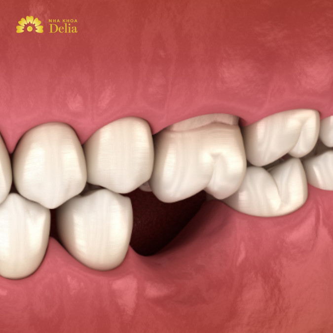 Trả lời: Mất răng số 6 nên trồng răng Implant hay bắc cầu tốt hơn?