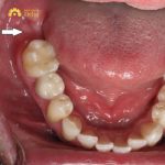 Hỏi đáp: Mất răng số 7 nên trồng răng Implant hay bắc cầu?