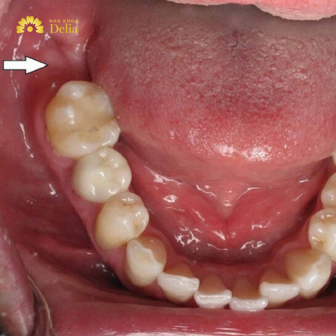 Hỏi đáp: Mất răng số 7 nên trồng răng Implant hay bắc cầu?