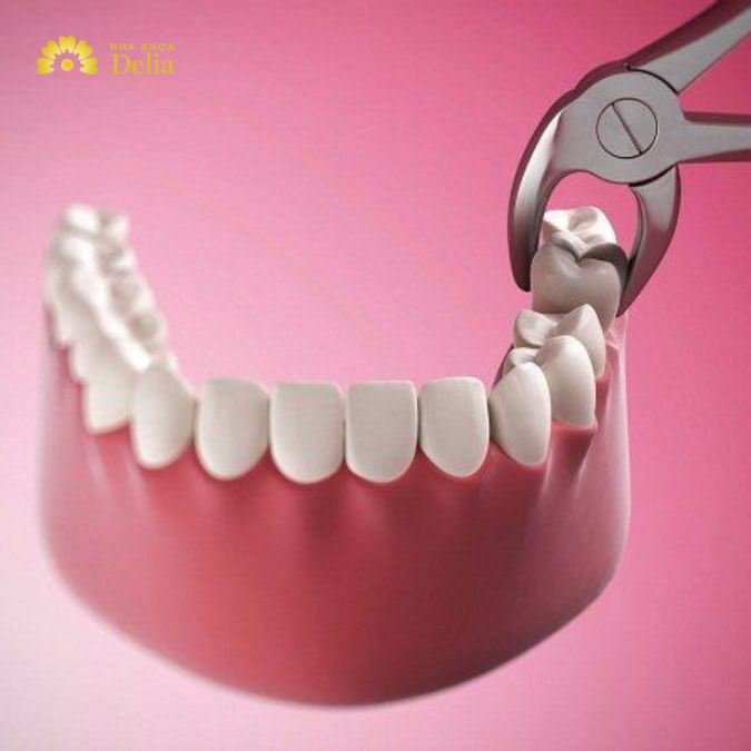 Nhổ 8 răng để niềng chỉ được thực hiện trong trường hợp nào?