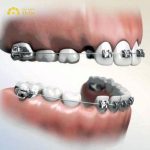 Nhổ răng để niềng là một phần của quy trình chỉnh nha