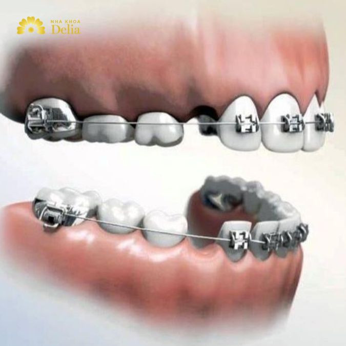 Trả lời: 29 tuổi có nên niềng răng, liệu có hiệu quả cao không?