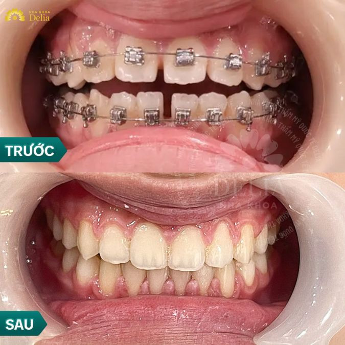 Những người không nên niềng răng và nên niềng răng là ai?