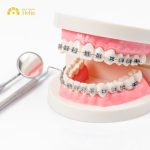 Niềng kéo răng 7 8 là kỹ thuật chỉnh nha được sử dụng để điều chỉnh vị trí của các răng số 7 và 8