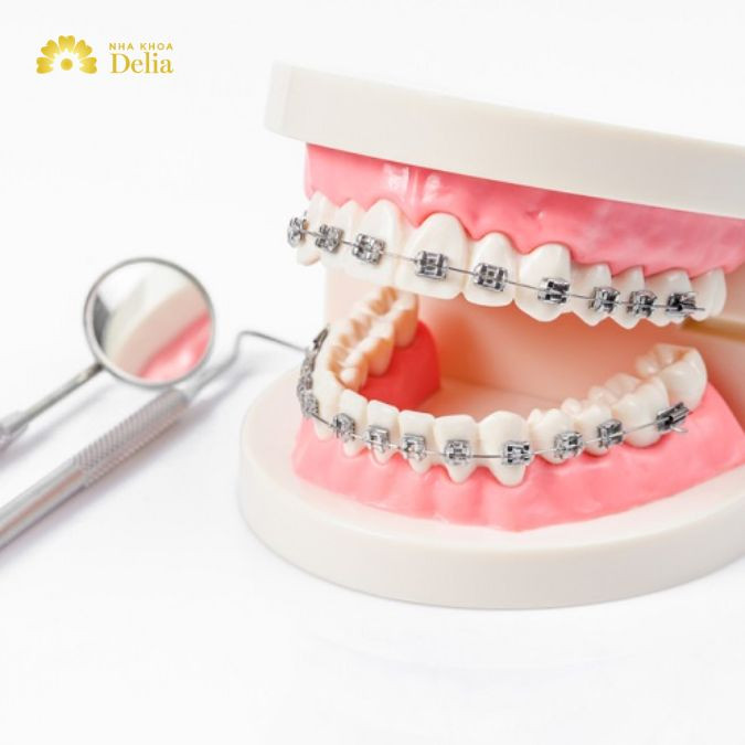 Trả lời: Niềng răng cho trẻ 9 tuổi có hiệu quả không?
