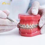 rong trường hợp răng số 7 và 8 gây ra khớp cắn không đều việc niềng kéo có thể giúp điều chỉnh lại vị trí của răng