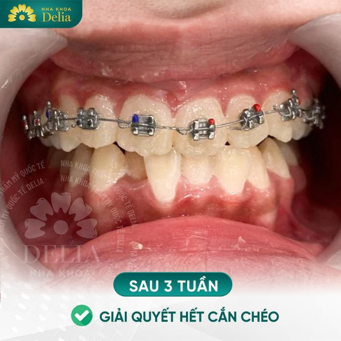 [Giải đáp] Niềng răng có được vĩnh viễn không?