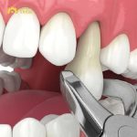 Niềng răng nhổ 4 cái là như thế nào, khi nào nên áp dụng?