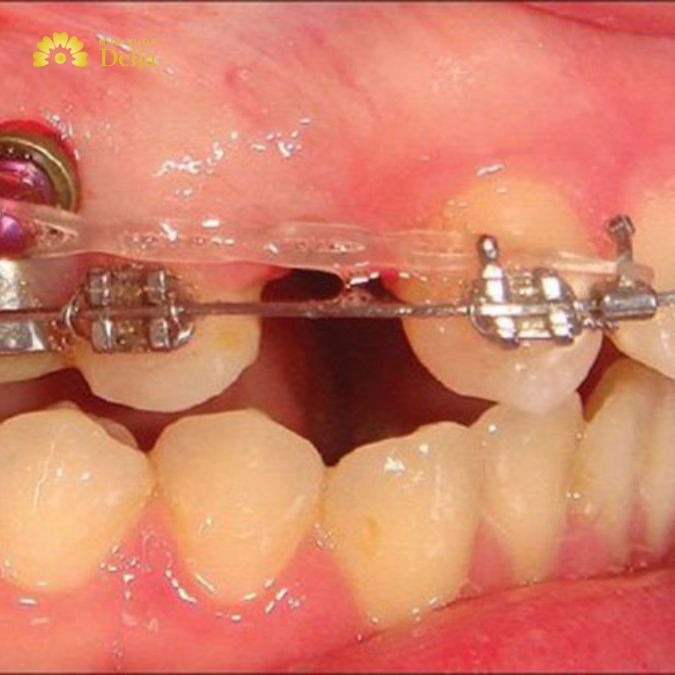 Niềng răng cho trẻ 8 tuổi giá bao nhiêu, có nên thực hiện không?