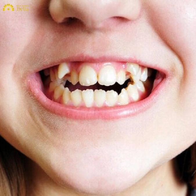 Răng 9630 nên bọc sứ hay niềng răng là tốt nhất?