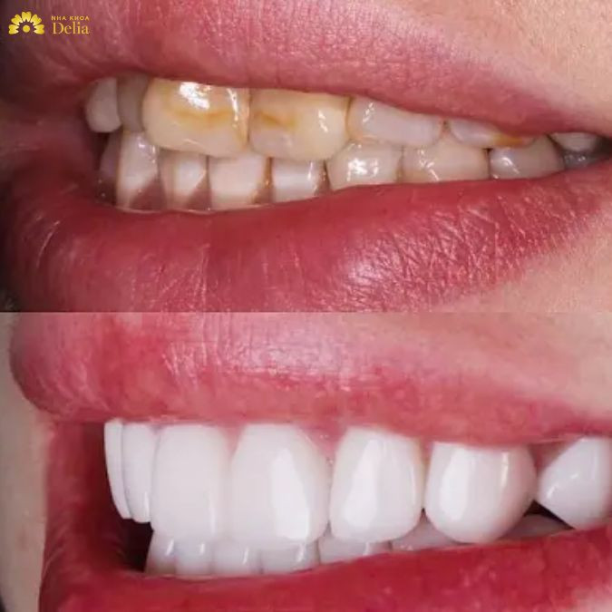 #Câu chuyện khách hàng: Thu Hằng – Thẩm mỹ 20 răng sứ Emax