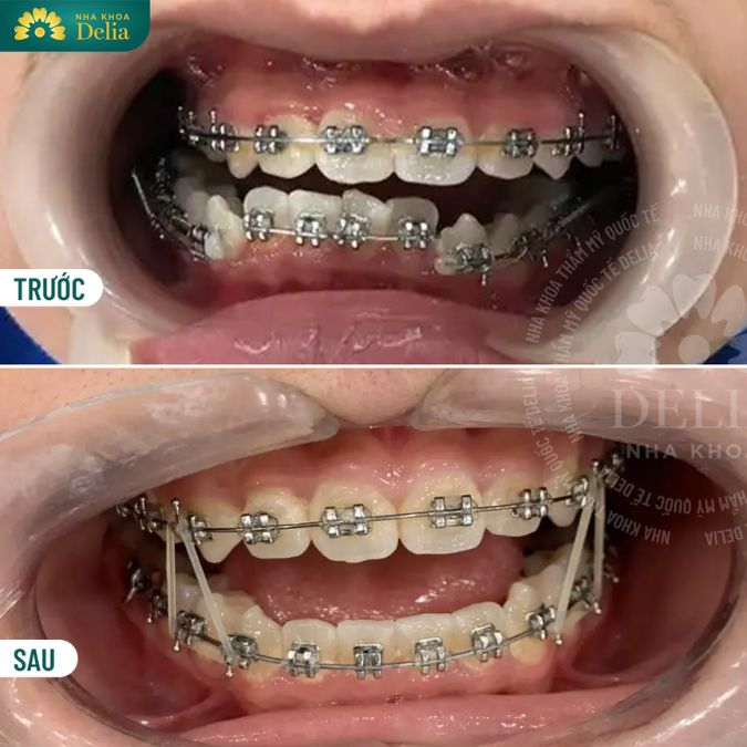 Răng mọc lệch nên bọc sứ hay niềng răng hiệu quả?