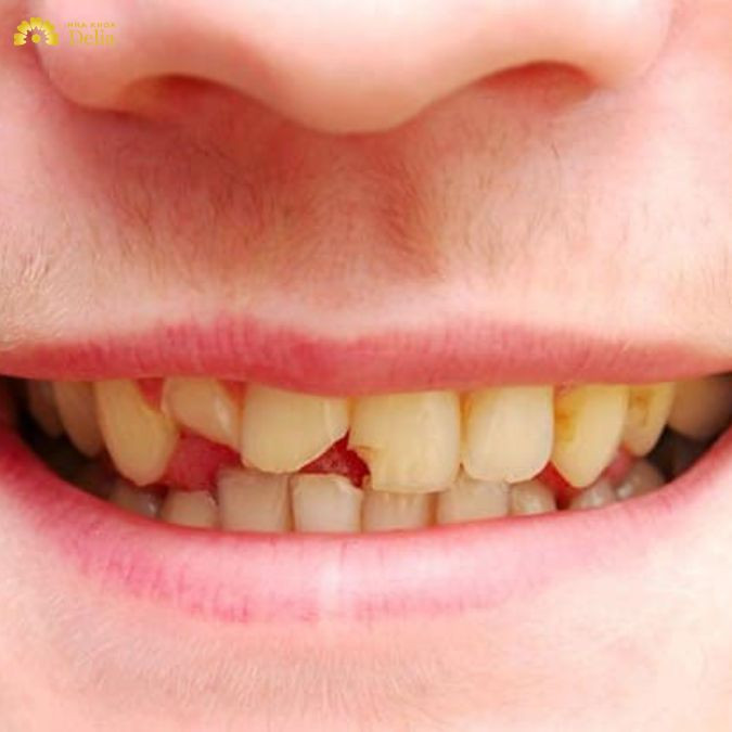 Răng sứ bị mẻ có được bảo hành không, điều kiện để bảo hành?