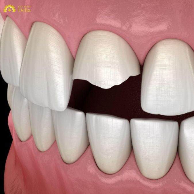 Trả lời thắc mắc: Răng sứt mẻ có nên bọc răng sứ không?