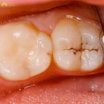 Ở giai đoạn đầu tiên, sâu răng độ một thường biểu hiện bằng những đốm trắng đục hoặc những chấm nhỏ màu đen