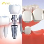 So sánh giá trồng răng Implant và bắc cầu, kỹ thuật nào đắt hơn?