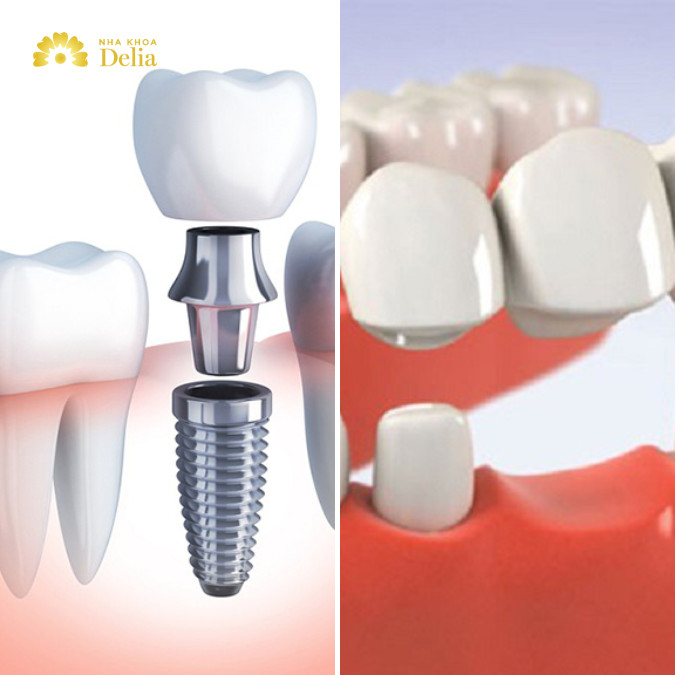 So sánh giá trồng răng Implant và bắc cầu, kỹ thuật nào đắt hơn?