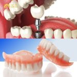 So sánh giá trồng răng Implant và hàm tháo lắp, nên áp dụng phương pháp nào?