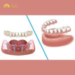 So sánh trồng răng Implant và hàm tháo lắp, phương pháp nào tối ưu hơn?