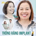 Việt kiều Canada trồng răng Implant tại Việt Nam địa chỉ nào uy tín?