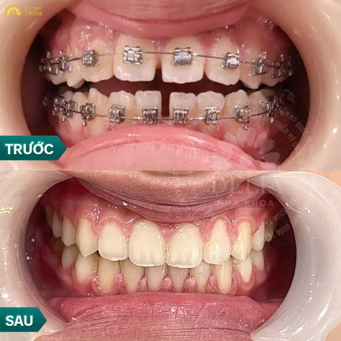 28 tuổi niềng răng được không? Bác sĩ trả lời nhanh