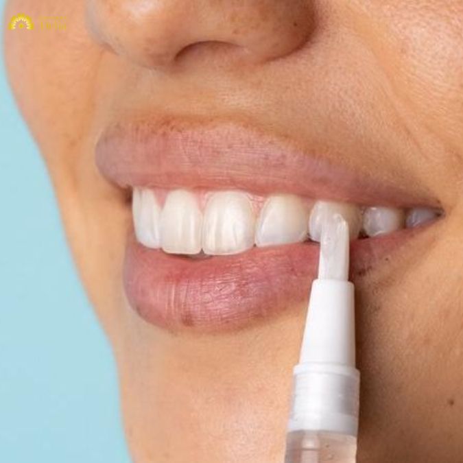 Bút tẩy trắng răng – Giải pháp tiện lợi sở hữu răng trắng 10 điểm