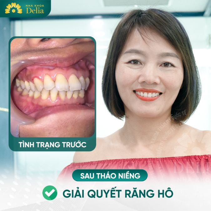 Làm thế nào để răng hô vẫn đẹp, không cần đến nha sĩ?