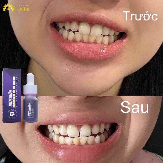Serum trắng răng có tốt? Nên sử dụng hay không?