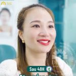 Hàm răng sứ Emax - Thay đổi cuộc đời của chị Thủy