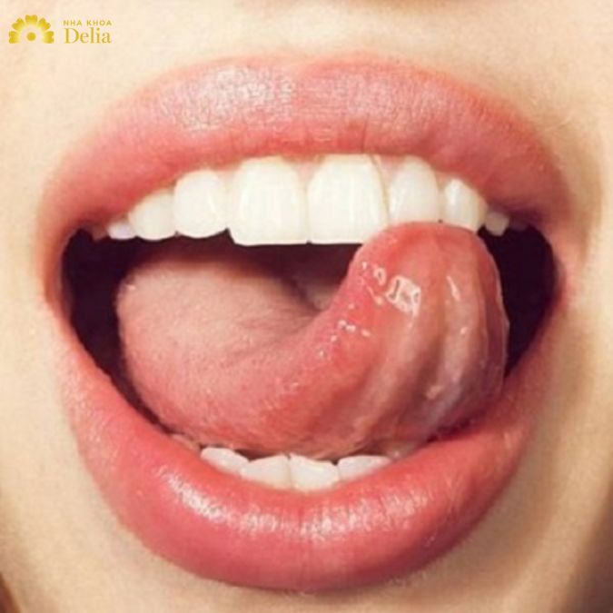 TOP 3 cách chữa răng hô tại nhà phổ biến nhất hiện nay