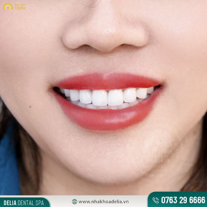 Làm thế nào để sở hữu nụ cười rạng rỡ? Tự tin tỏa sáng?