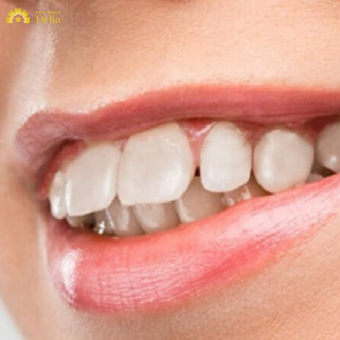 Xem tướng người răng hô – Cách cải thiện như thế nào?