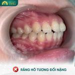 Răng hô nặng có thể được điều trị bằng nhiều phương pháp khác nhau