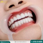 Dáng răng tự nhiên là lựa chọn an toàn cho mọi khuôn mặt