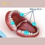Mất răng số 6 hàm dưới phải làm sao? Bác sĩ giải đáp nhanh