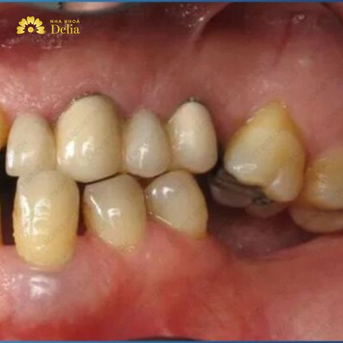 Trả lời: Mất răng số 7 hàm dưới có nghiêm trọng không?