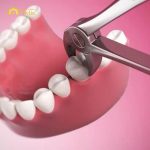 Nhổ răng số 6 có bị hóp má không, có nguy hiểm không?