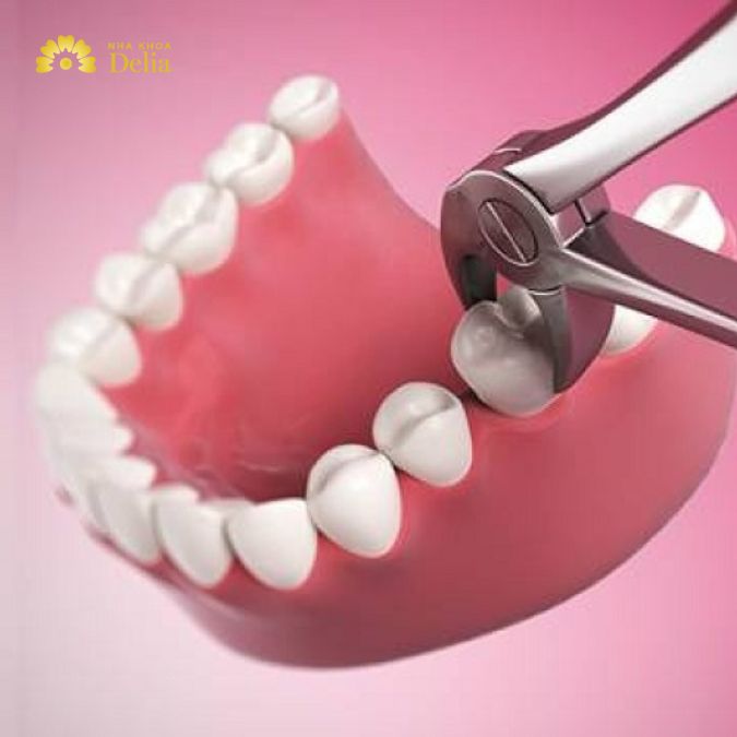 Nhổ răng số 7 có nguy hiểm không? Bác sĩ giải đáp nhanh