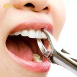 Nhổ răng vĩnh viễn có đau không, quy trình nhổ răng như thế nào?