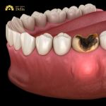 Răng số 6 bị sâu vỡ phải làm sao? Bác sĩ giải đáp nhanh