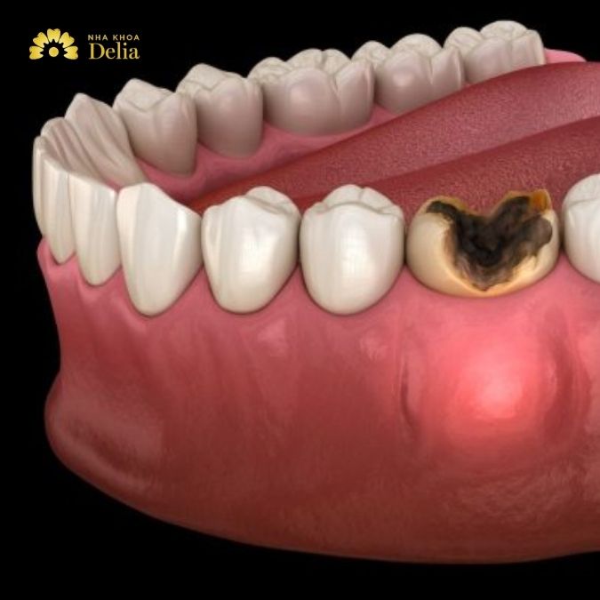 Răng số 6 bị sâu vỡ phải làm sao? Bác sĩ giải đáp nhanh