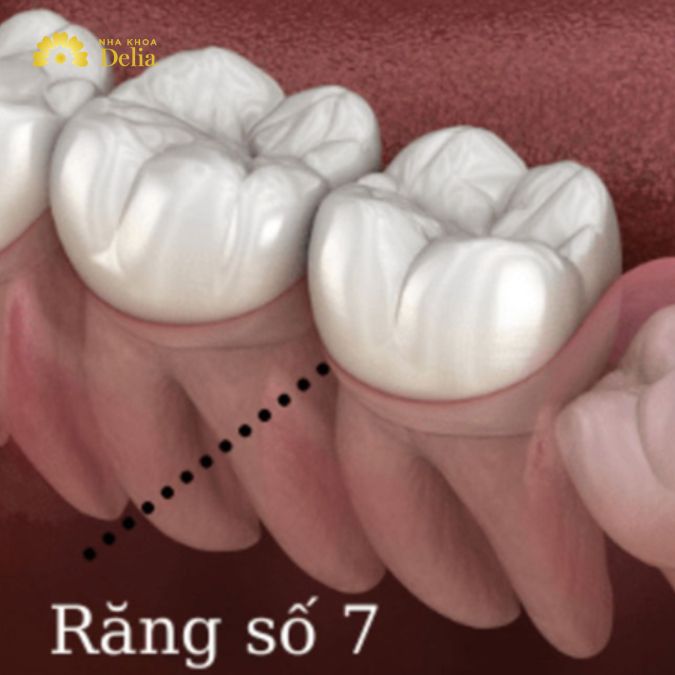 Răng số 7 là răng nào? Tìm hiểu thông tin về răng số 7