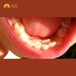 Răng sữa chưa rụng răng vĩnh viễn đã mọc phải làm sao?