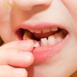 Răng vĩnh viễn bị lung lay thì phải làm sao? Hỏi đáp nhanh với bác sĩ